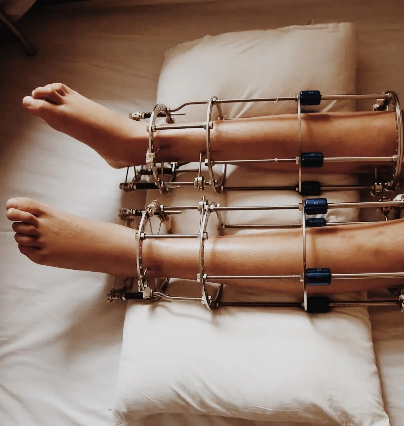 جراحة تطويل الساق